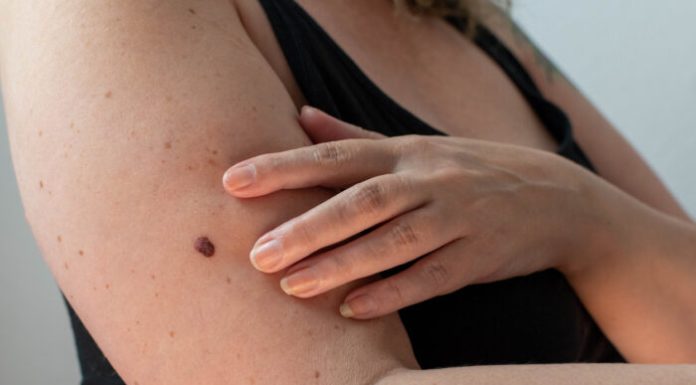 Dermatolozi upozoravaju: evo šta znači kada dlake rastu iz mladeža!