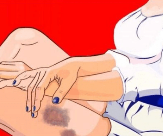 Jeste li se ikada probudili s modricom, a da niste znali odakle je? Ovo je moguće objašnjenje.